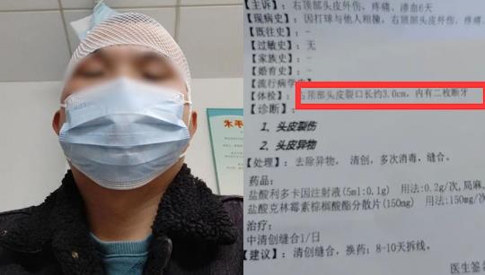 男子打球6天后頭皮里發現2顆牙，網友神評論