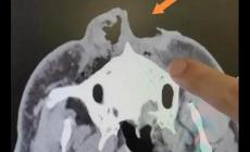 驚險(xiǎn)！男子上山采菌被熊咬掉一半鼻子，怎么回事？